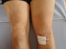 前十時靭帯再建手術後_1