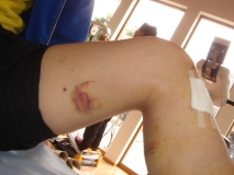 前十時靭帯再建手術後_2